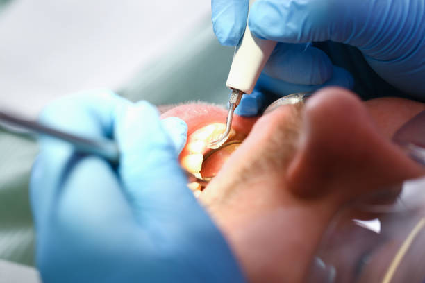 Best Emergency Tooth Extraction in Sheldon, IL